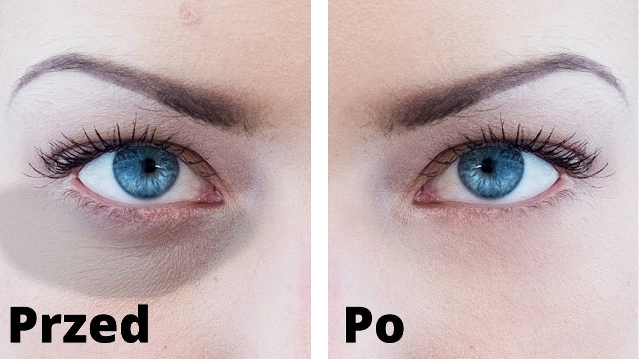 Worki pod oczami - Pozbądź się ich tymi domowymi sposobami!