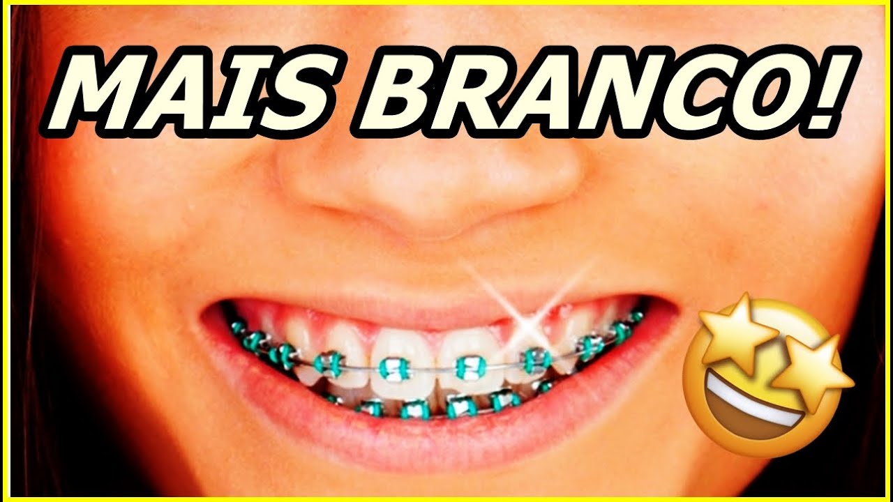 CORES DO APARELHO QUE DEIXAM O DENTE MAIS BRANCO!