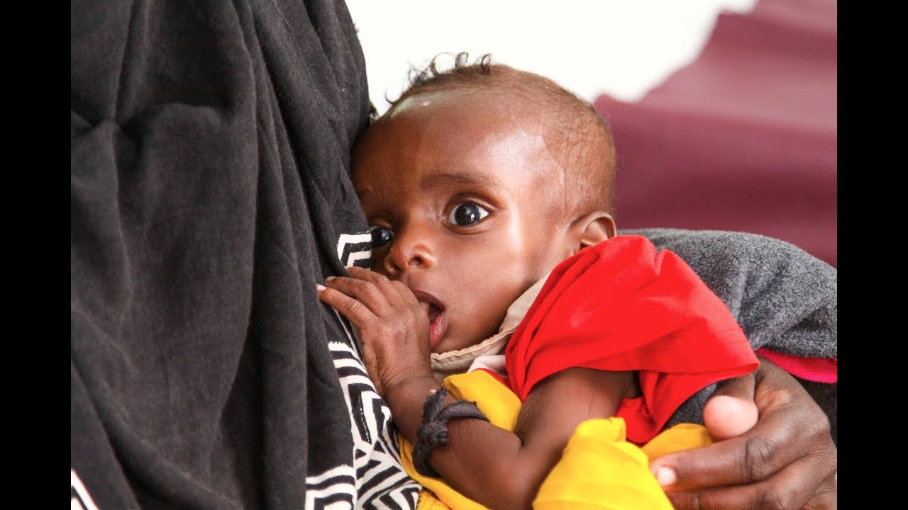 More children suffer malnutrition in drought-hit Somalia