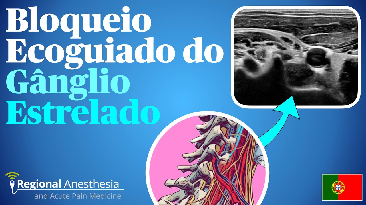 Bloqueio Ecoguiado do Gânglio Estrelado