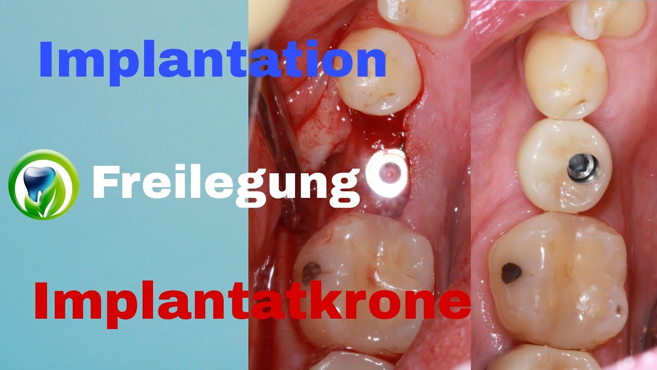 Zahnimplantation, Freilegung, Abformung, Implantatkrone - Ablauf | Zeitraum | Dauer | Termine