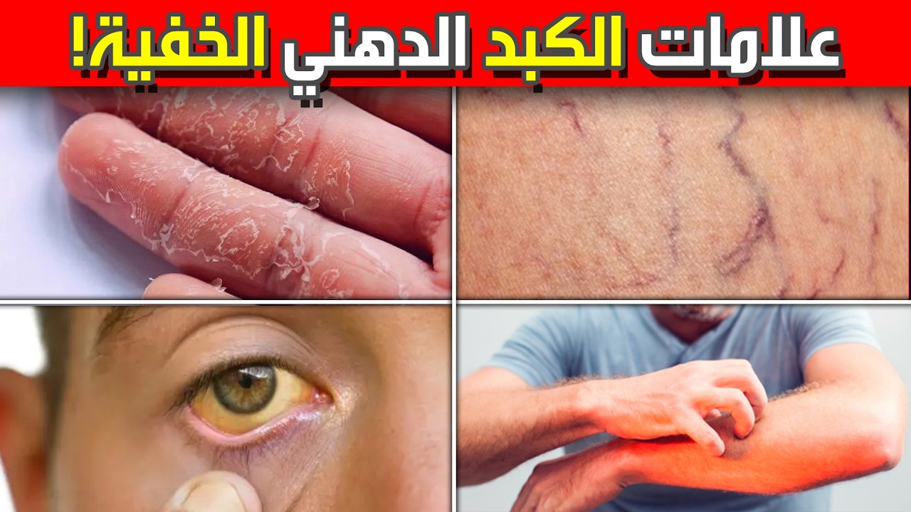 7 علامات صادمة عندك كبد دهني و اقوى علاج طبيعي (بشهرين!)