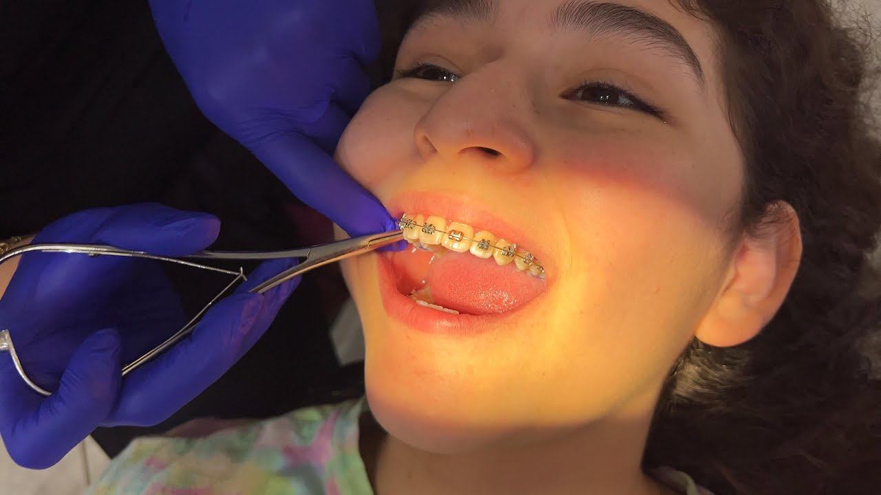 AJUSTE DE BRACKETS Y CAMBIO DE LIGAS | YESLY VLOGS