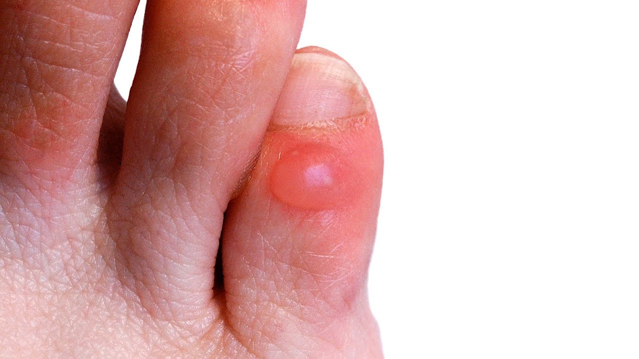 How to Prevent & Treat Foot Blisters | Foot Care