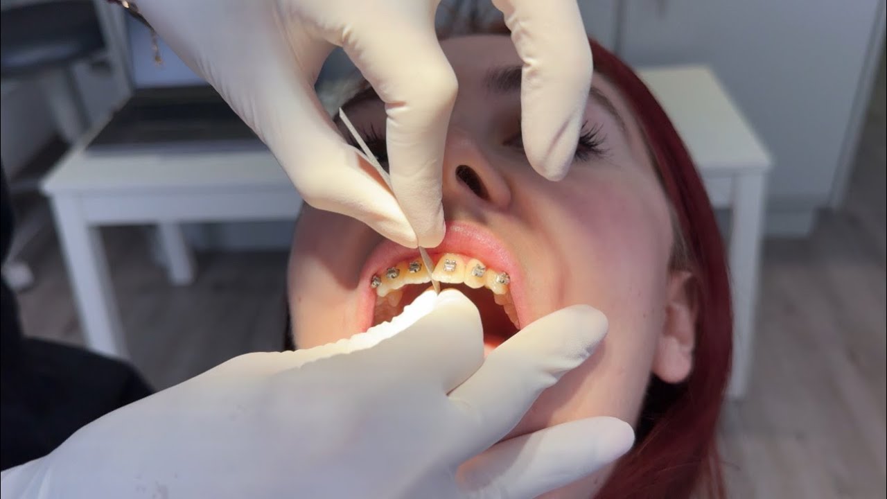 BRACES UPDATE painful IPR treatment