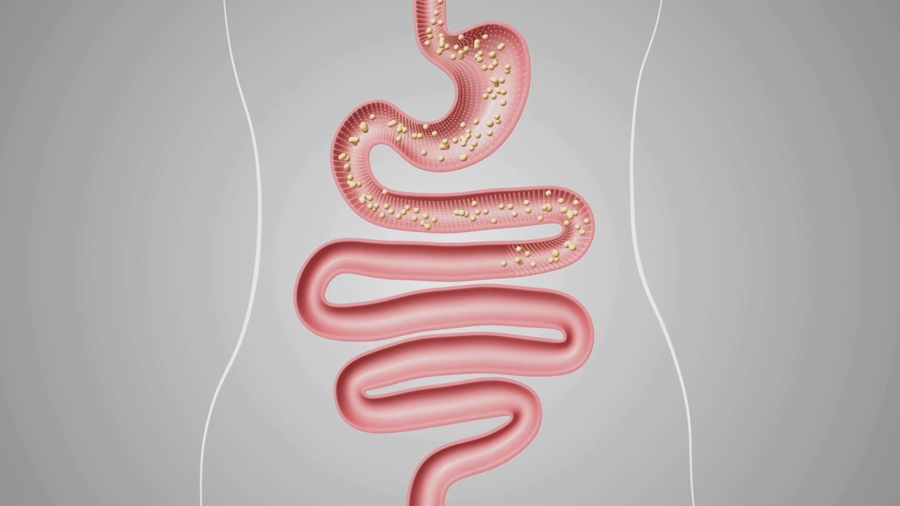 Malattie infiammatorie intestinali, cosa mangiare