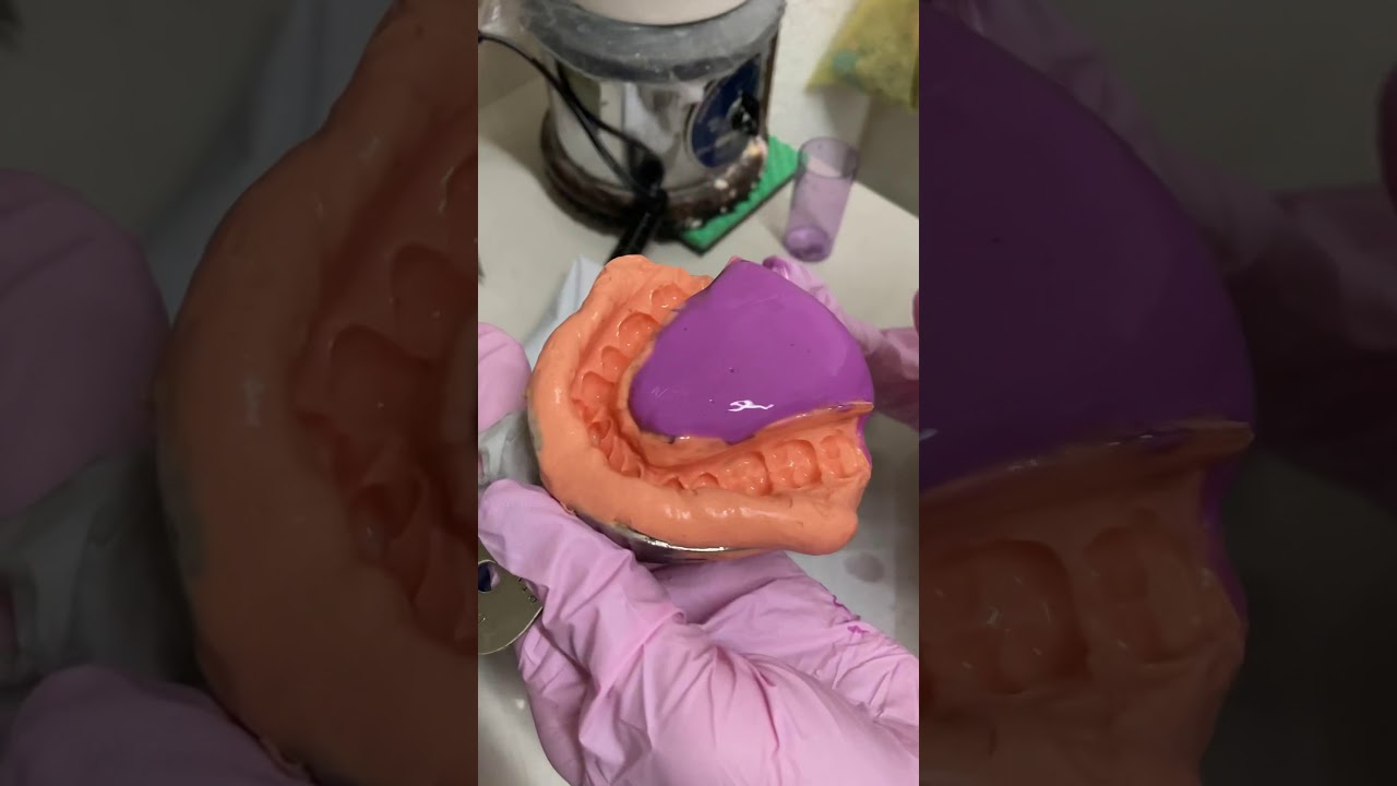 Impresión total inferior con alginato y vaciado en yeso tipo III