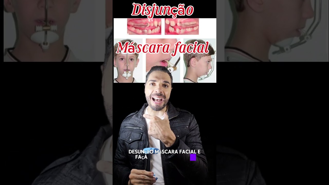 IDADE CERTA PARA DESCRUZAR MORDIDA POSTERIOR E ANTERIOR NA CLASSE III. #ortodontia #odontologia