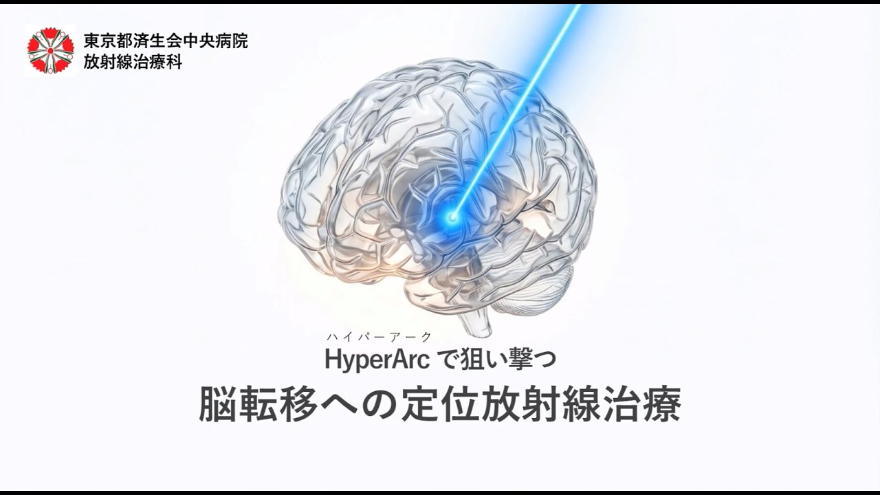 切らずに治す選択肢、脳転移への定位放射線治療｜東京都済生会中央病院
