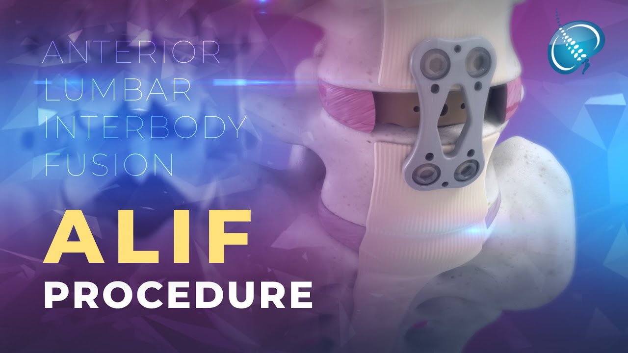 What is Anterior Lumbar Interbody Fusion? | ALIF