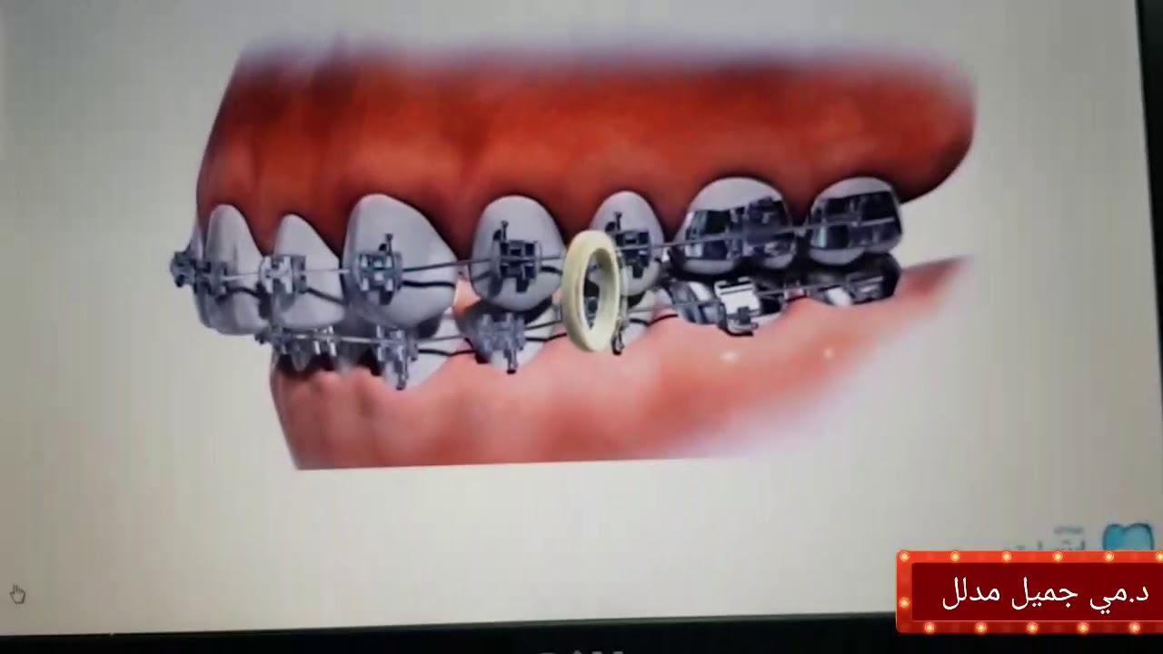 وظيفة المطاط في تقويم الاسنان... استمتع بالمشاهده