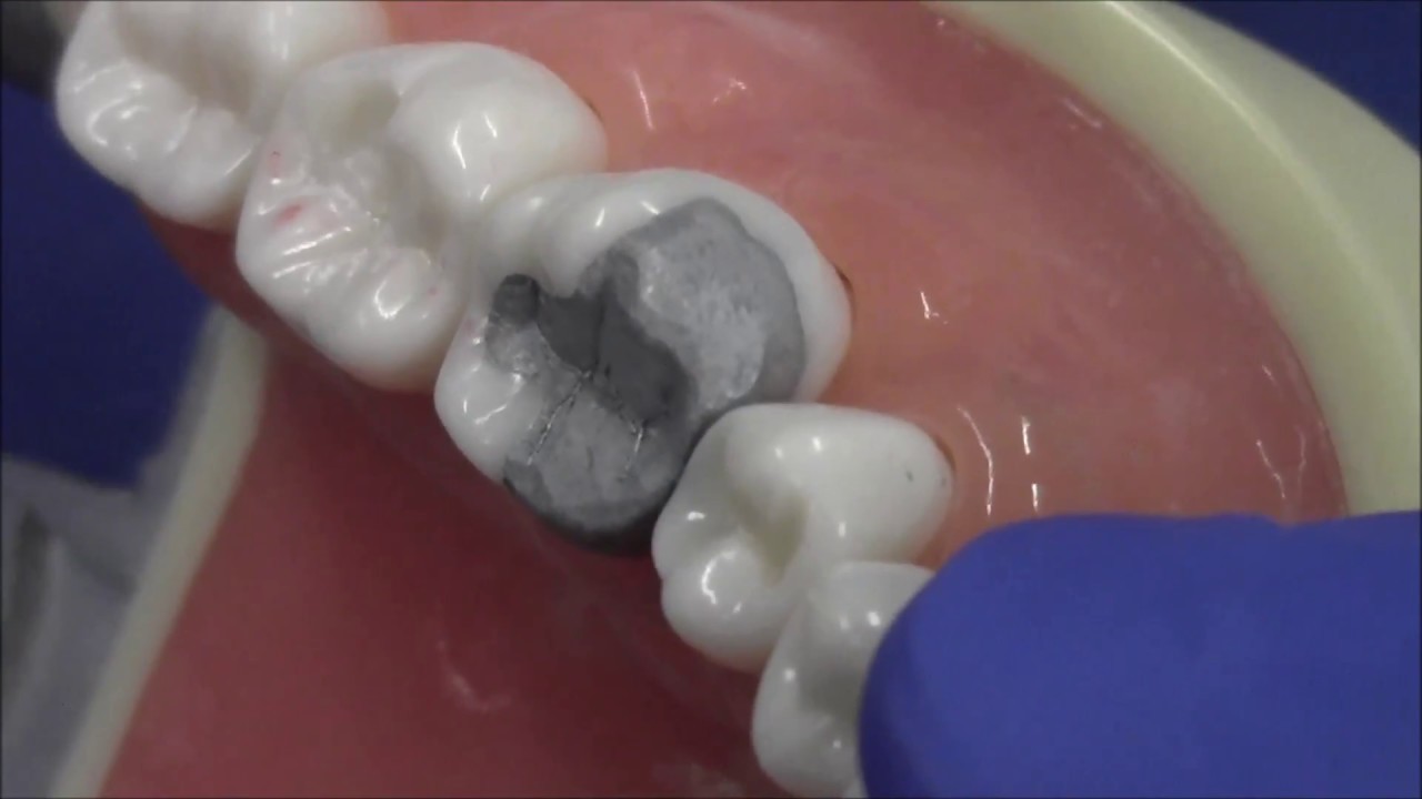 Complex restoration of #19 MOBL with silver amalgam
