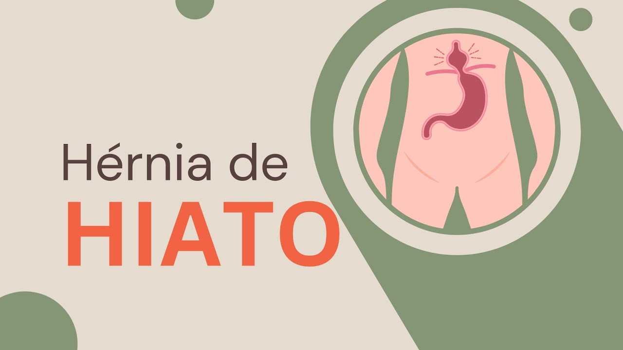 Como tratar a Hérnia de Hiato?