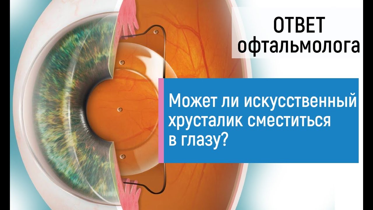 Может ли искусственный хрусталик после операции удаления катаракты сместиться в глазу или выпасть?