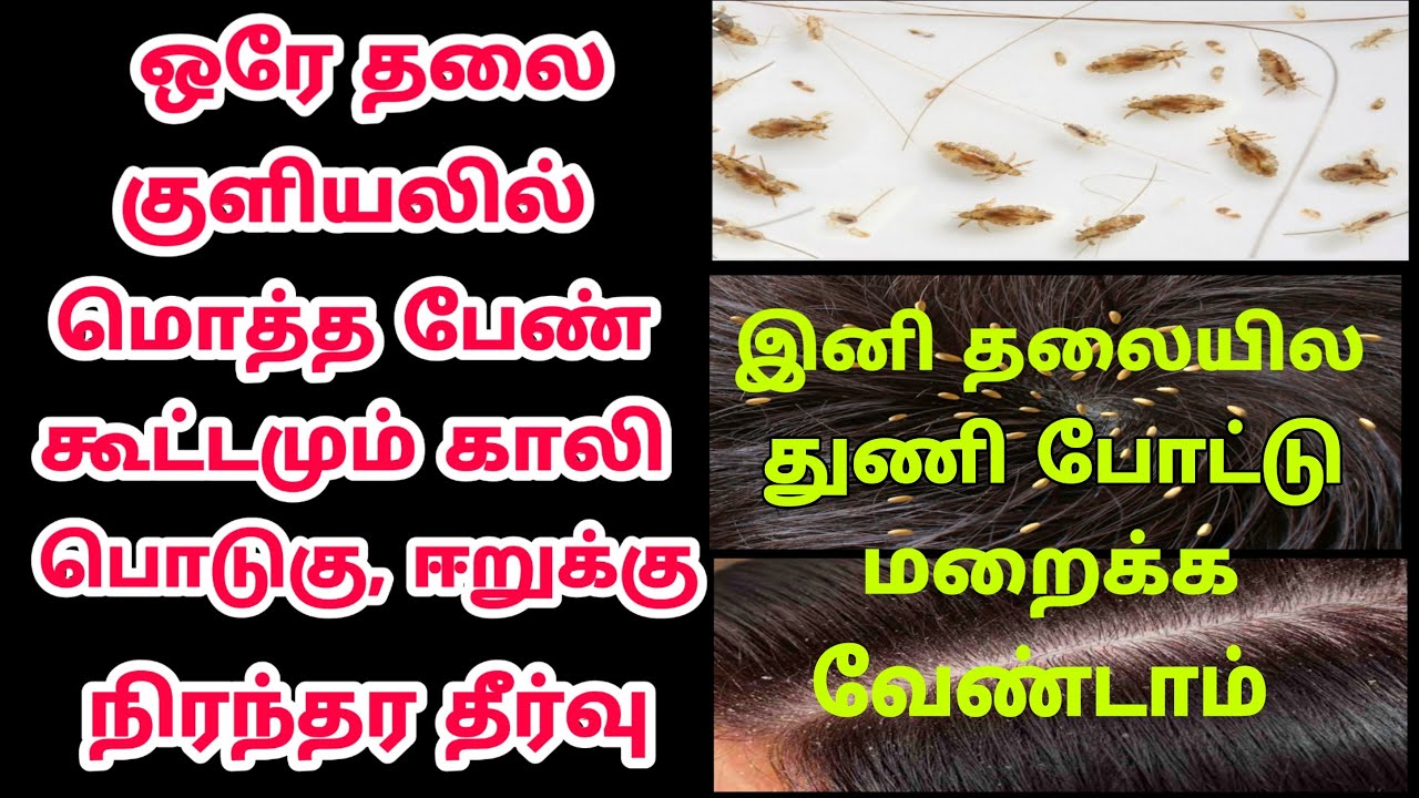 30 நிமிசத்துல தலையில இருக்க மொத்த பேணும் காலி/dandruff cleaning tips /Rasi Tips