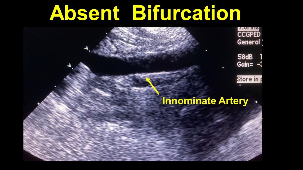 Aberrant Right Subclavian Artery