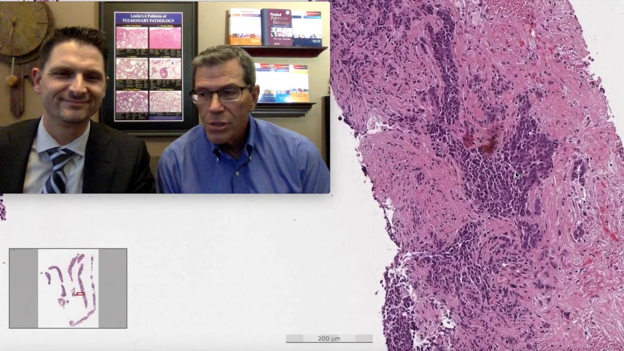 Pattern 5 – Nodules, Small Cell Carcinoma (Top 25 Pearls Series, Topic 5, Pearl 3)