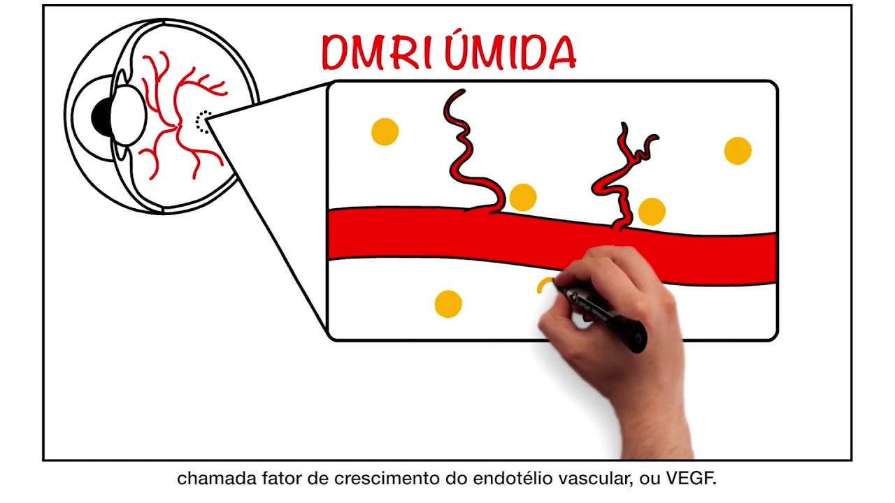 DEGENERAÇÃO MACULAR RELACIONADA A IDADE ou DMRI: Saiba tudo sobre esta doença!