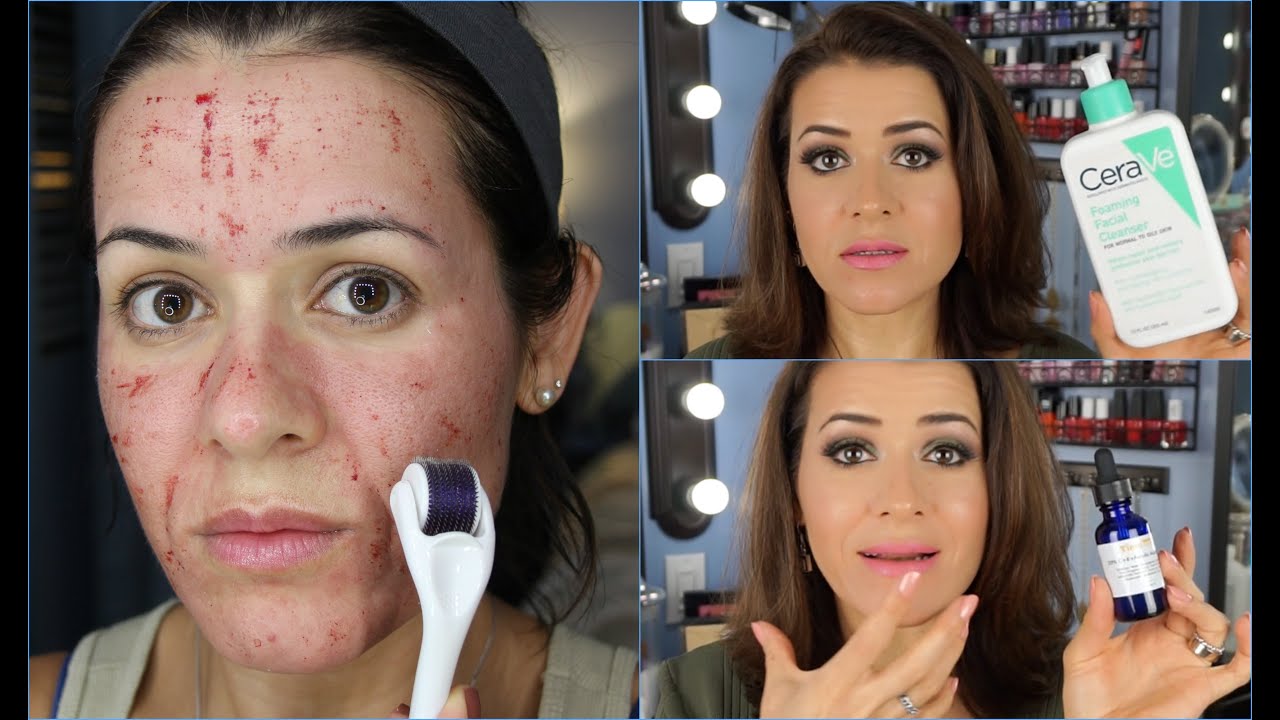 O que usar antes e depois do Microagulhamento? E foto de antes!
