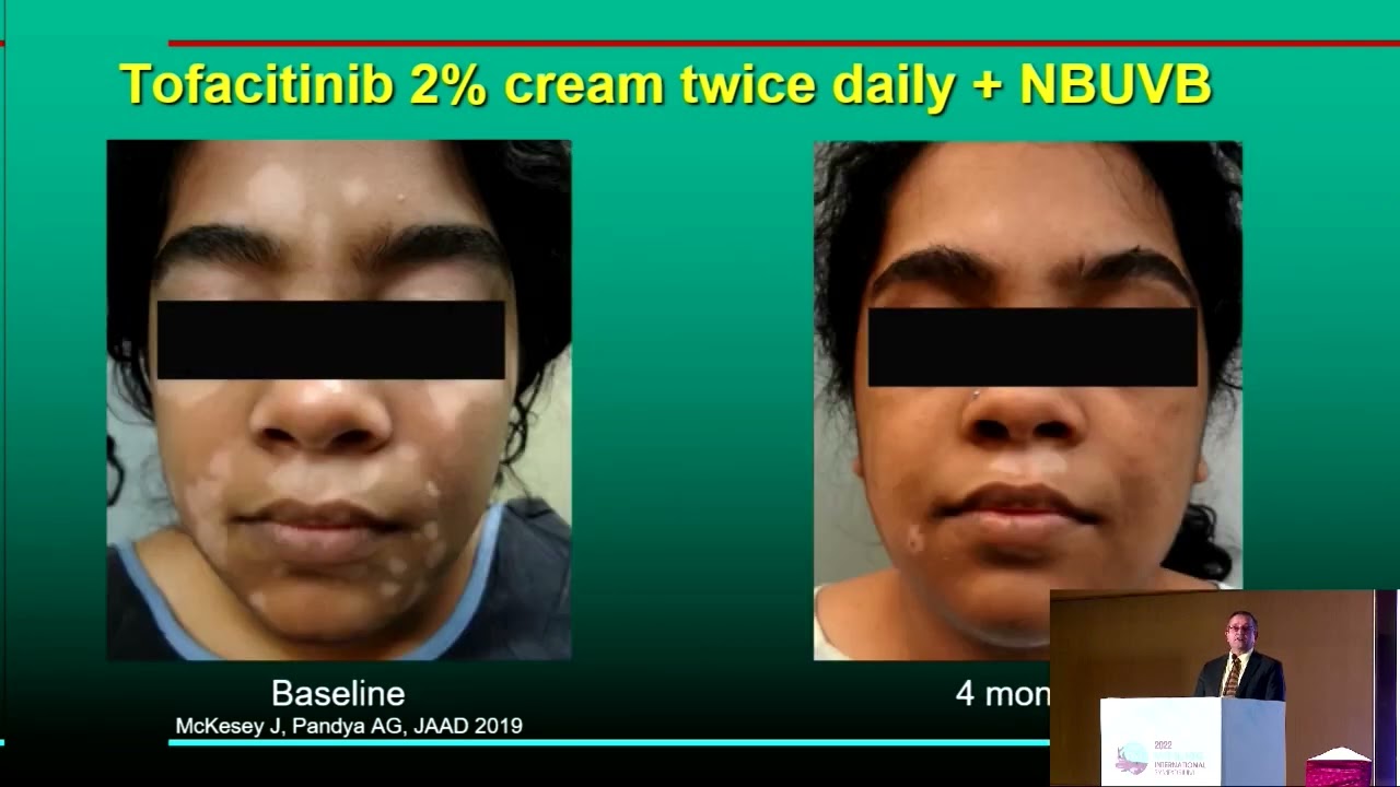 Invited Speaker: Update on Jak Inhibitors For Vitiligo