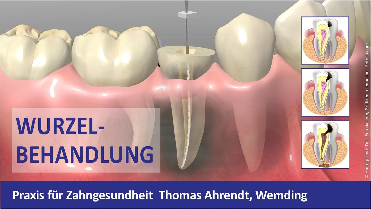 Wurzelbehandlung Zahnarzt Wemding - Thomas Ahrendt