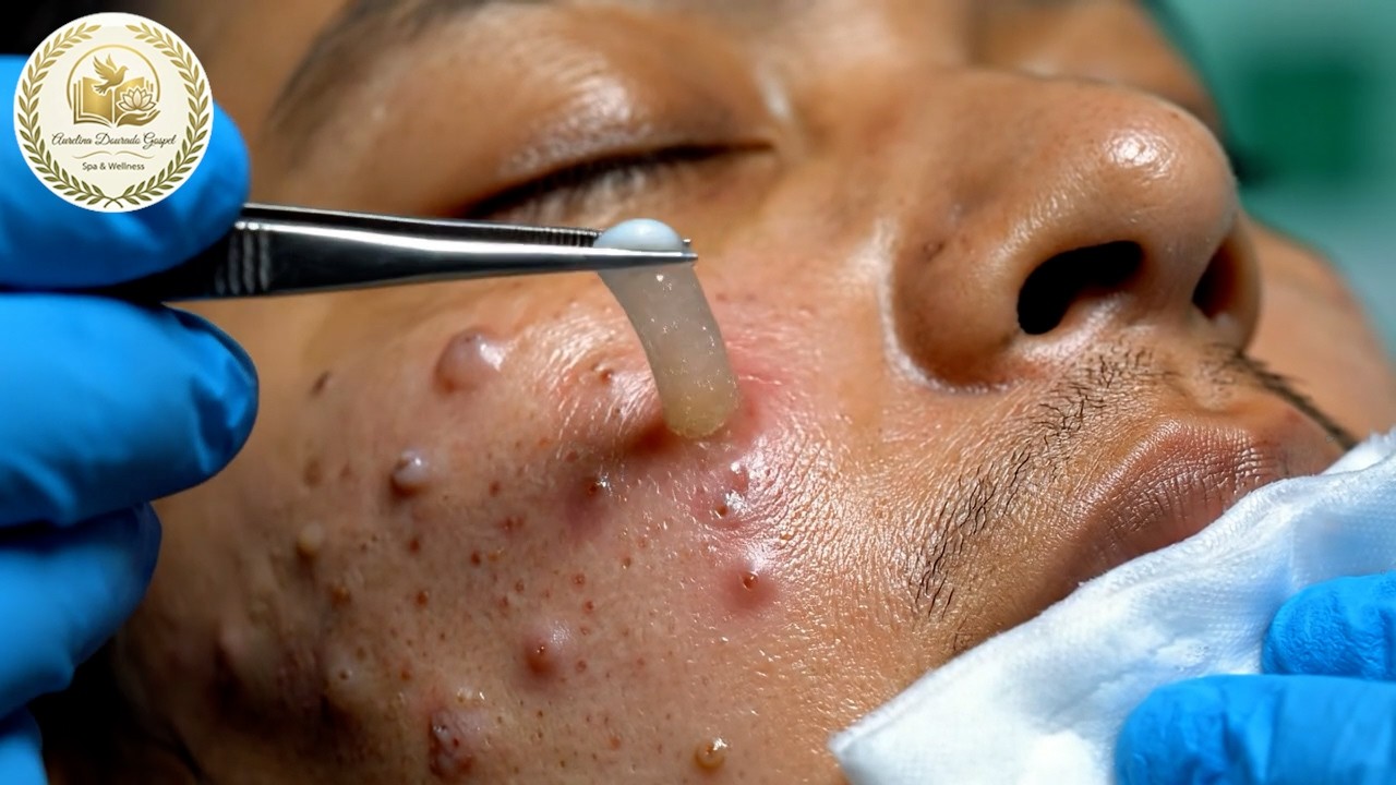 [ASMR] Dr. Lee’s professional blackhead spa 😌blink backward😌#18289