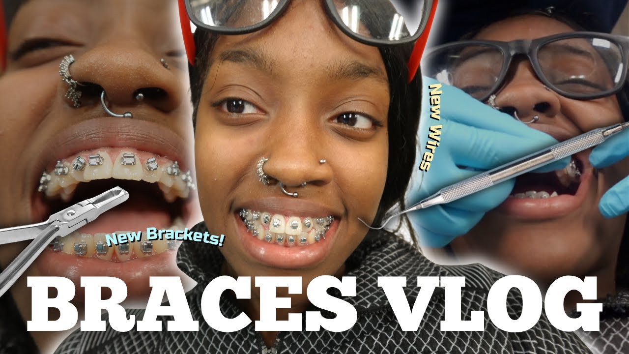 WHATS ITS LIKE GETTING BRACES *COME WITH ME * 