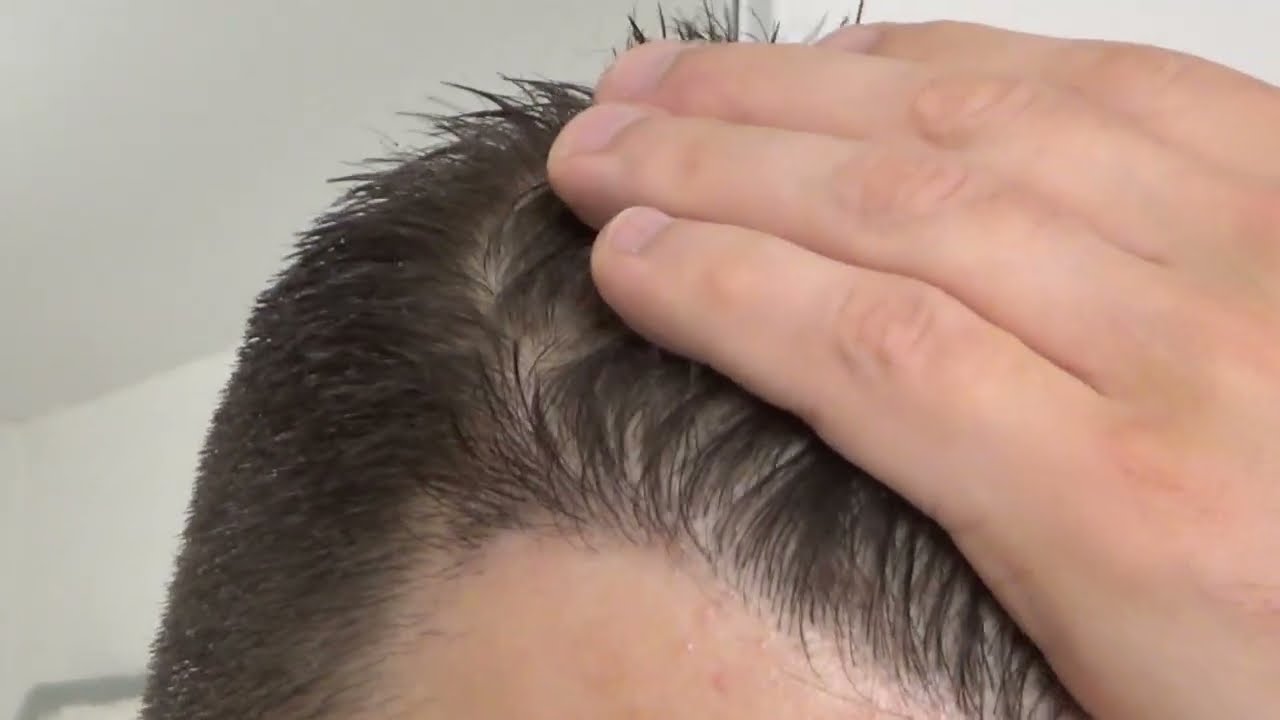 Week 33 (Day 235) FUE Hair Transplant & PRP: Post Op Recovery - Day 124 No Shampoo