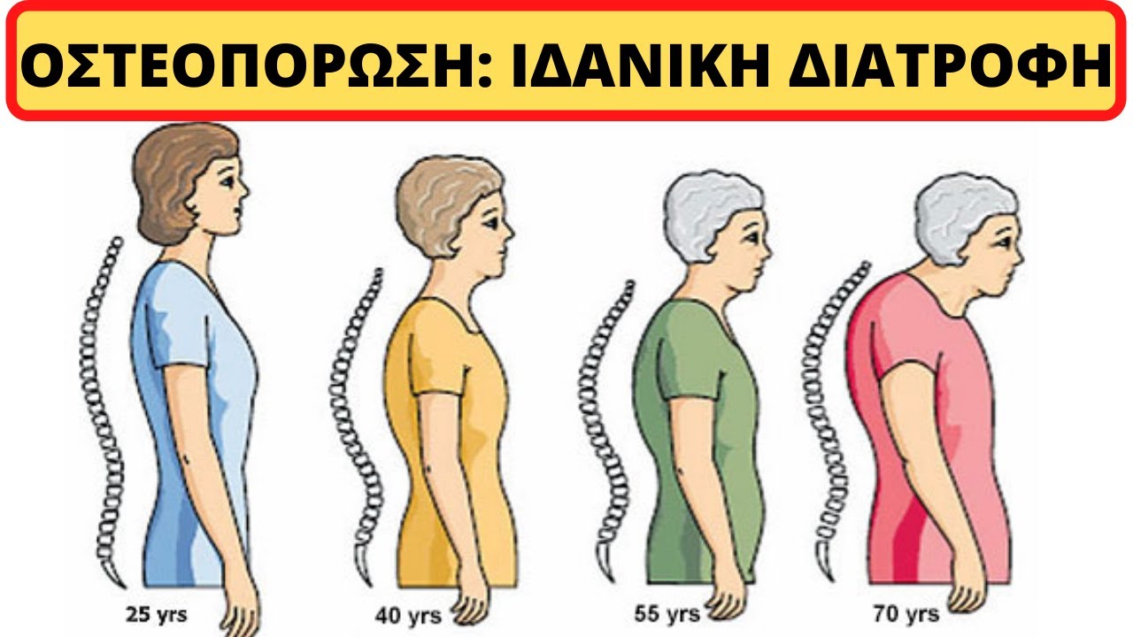 Οστεοπόρωση: Ιδανική Διατροφή