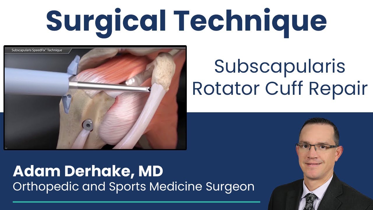 Subscapularis Rotator Cuff Repair:  Surgical Technique