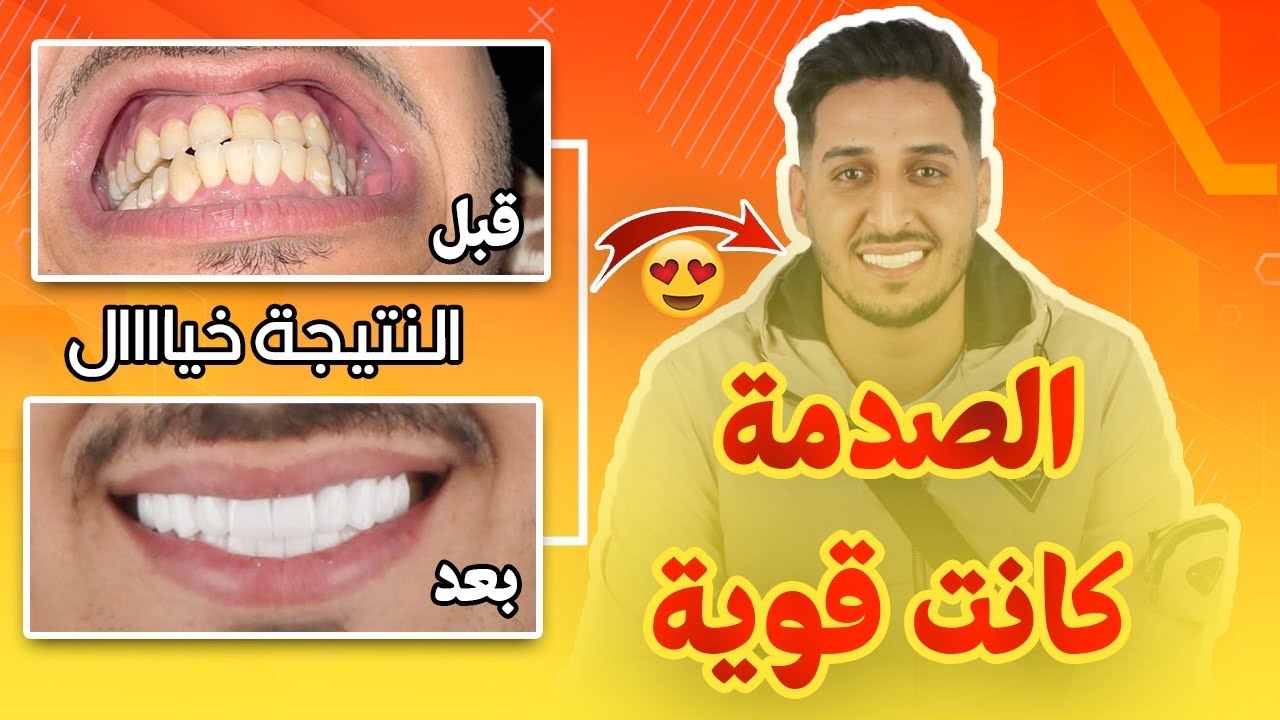 الحرشي مشا التركيا يدىر Hollywood Smile دخلو تشوفو النتيجة￼🔥🔥
