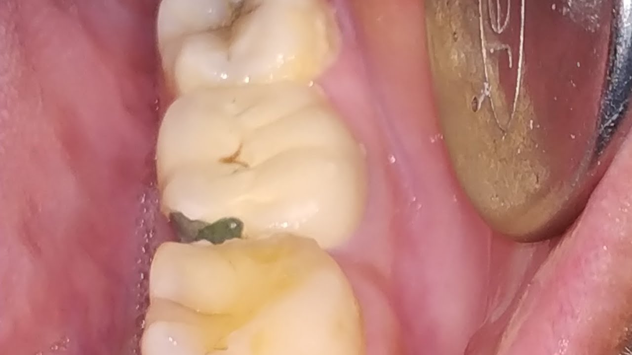 HOW TO MIX DENTAL CEMENTS AND PREVENT CHIPPING OF PFM CROWNS?
