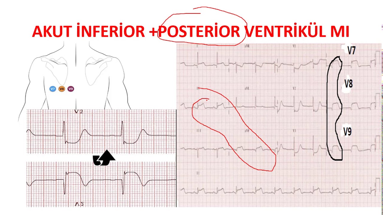 Elektrokardiyografi (EKG) - ST Yükselmeli Myokard Enfarktüsü TUS Kardiyoloji Konu Anlatımı