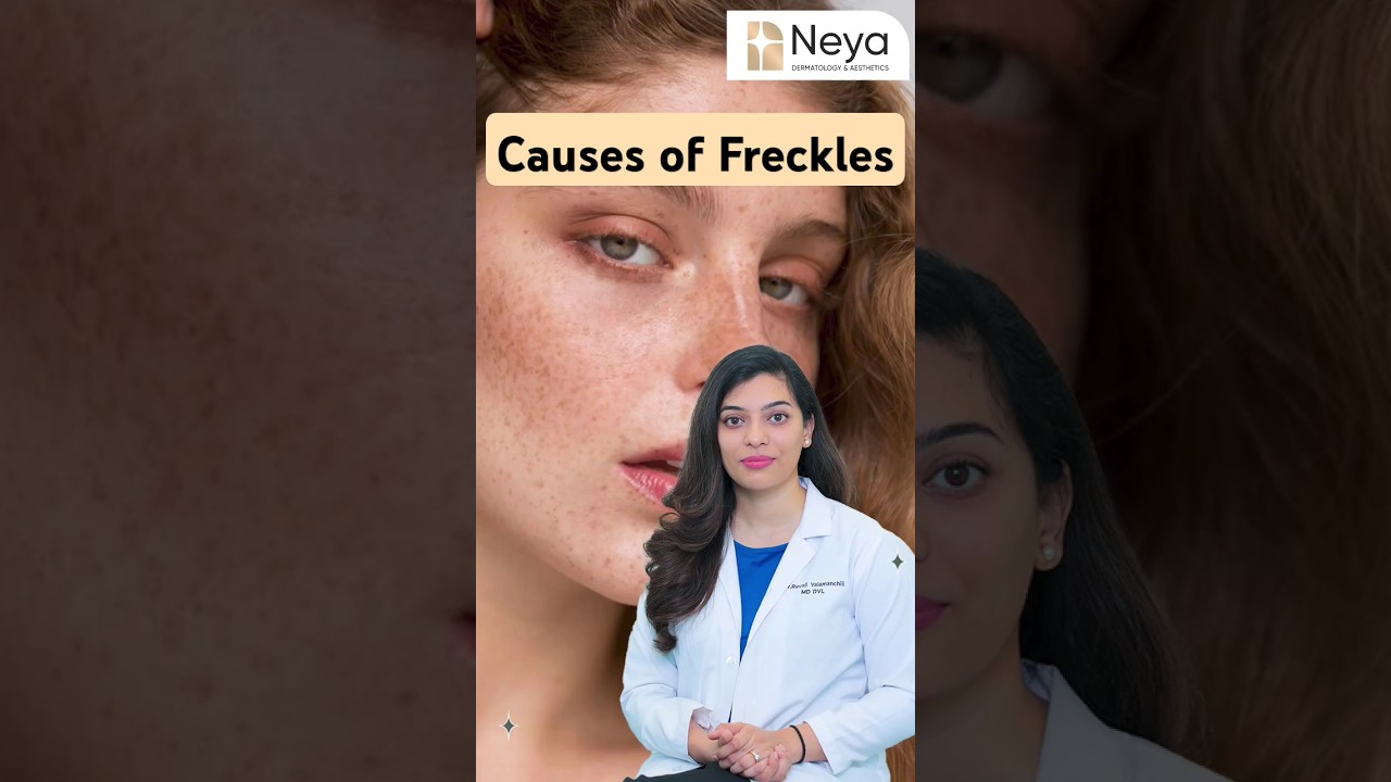 Causes of Freckles on Face | Sun exposure skin problems #frecklesface #freckles