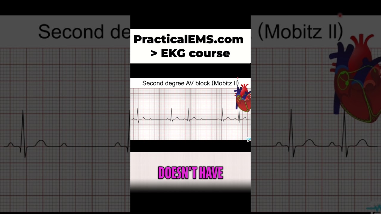 Mobitz Type 2 AV Block: Understand Dropped Beats Easily!