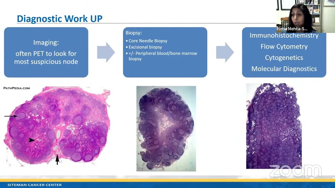 Making Progress in T-Cell Lymphomas