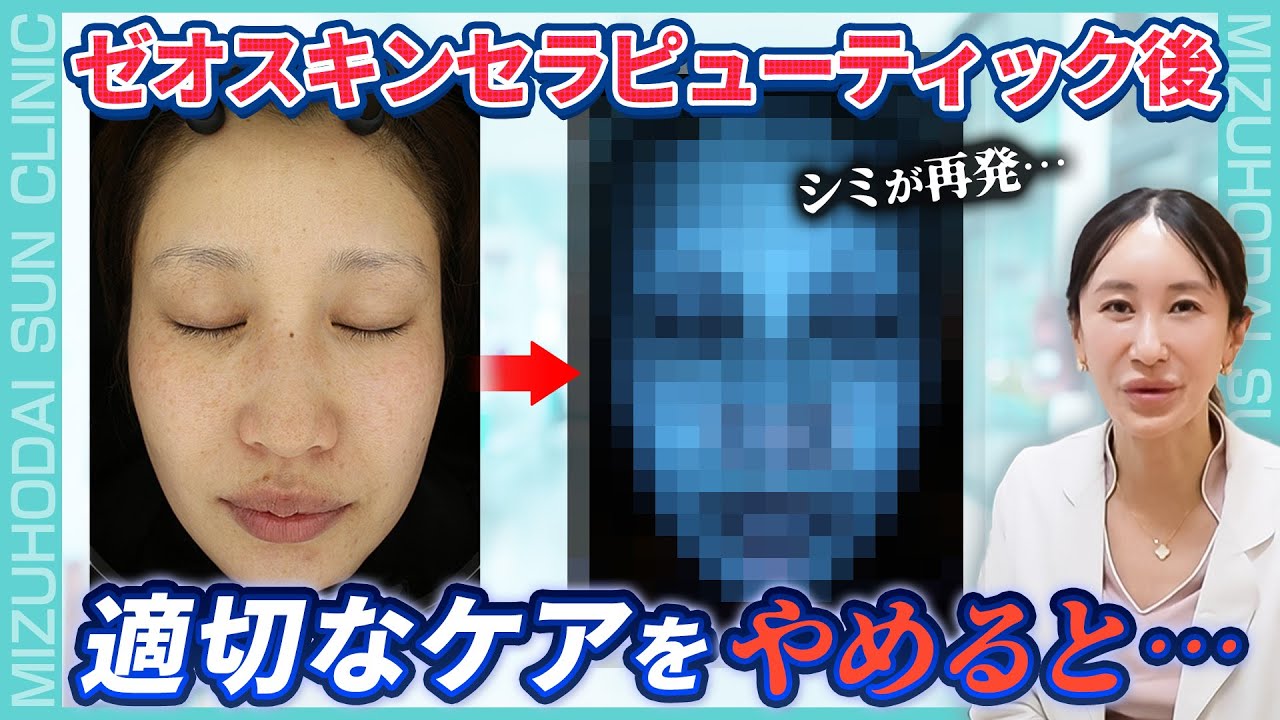 【ゼオスキン】セラピューティック後におすすめのお肌のケアと美容施術をご紹介します