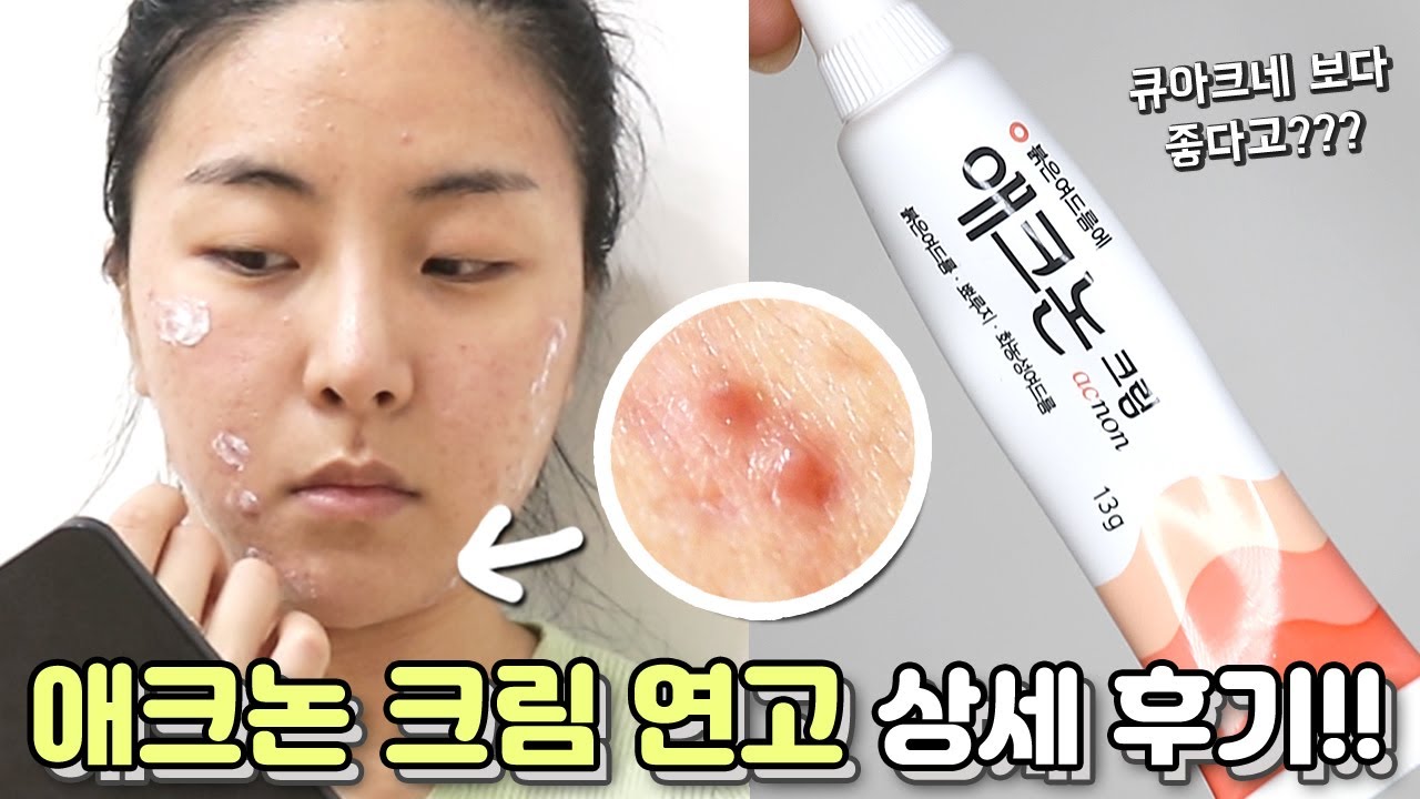 약국템 신상🔥🔥 애크논 크림 연고 여드름에 진짜 효과 있을까!?