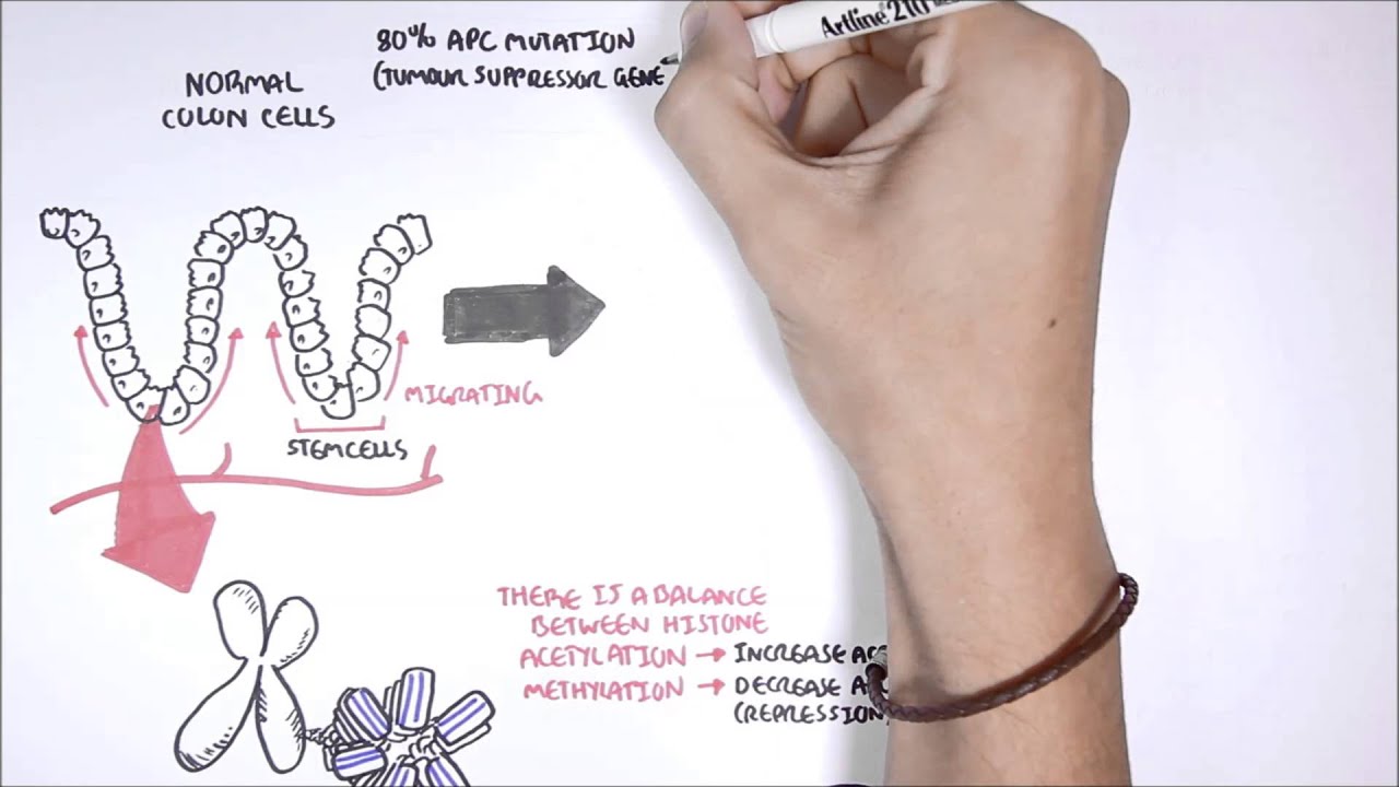 The Hungry Microbiome: Understanding colon cancer carcinogenesis