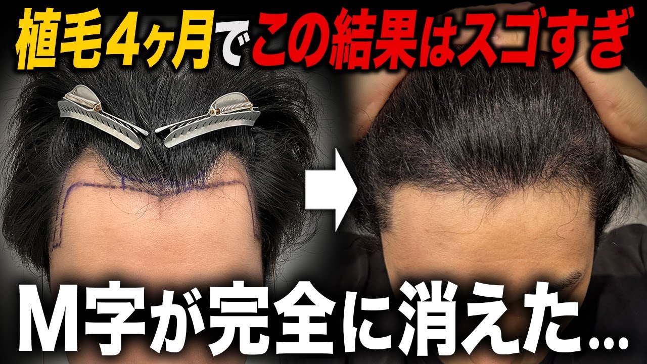 【最高傑作】植毛4ヶ月で自信がついて別人みたいになった姿が凄い