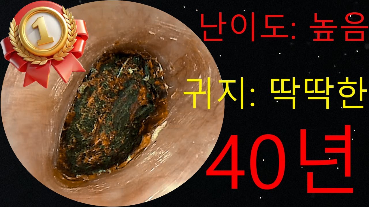 [충격] 귀 속에서 나온 40년된 '귀지 화석' | 난이도 최상 제거 과정