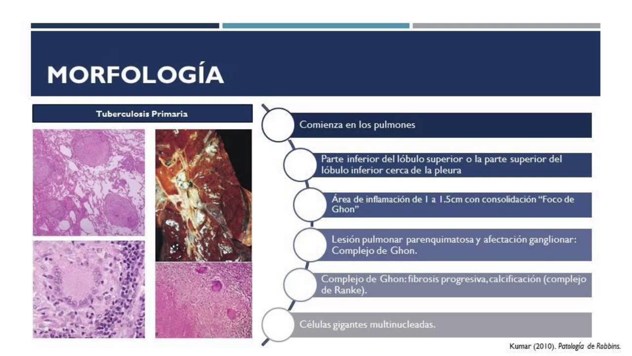 Tuberculosis