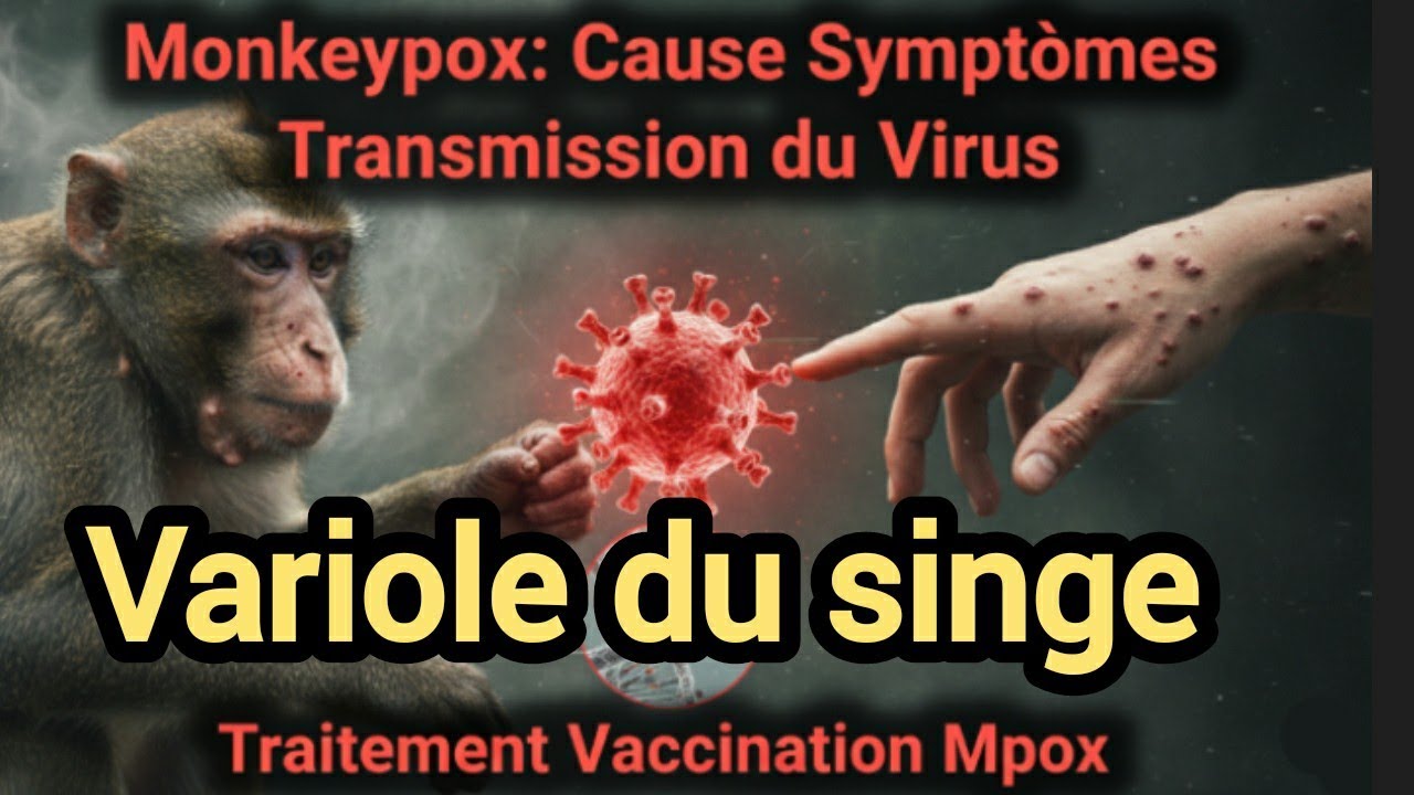Variole du Singe: Symptomes mode de Transmission Virus Mpox monkeypox Comment la Traiter?