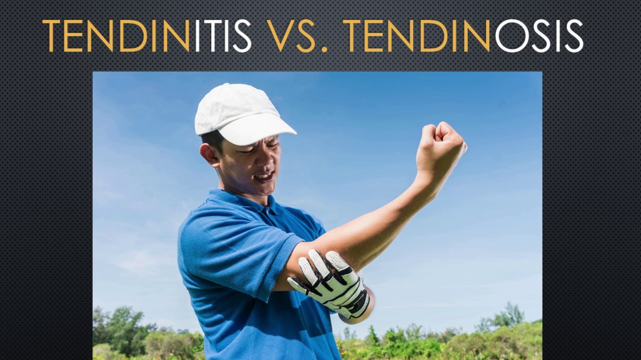 What are the Symptoms of Tendinitis? | What is Chronic Tendinosis? | Orange County, Lake Forest