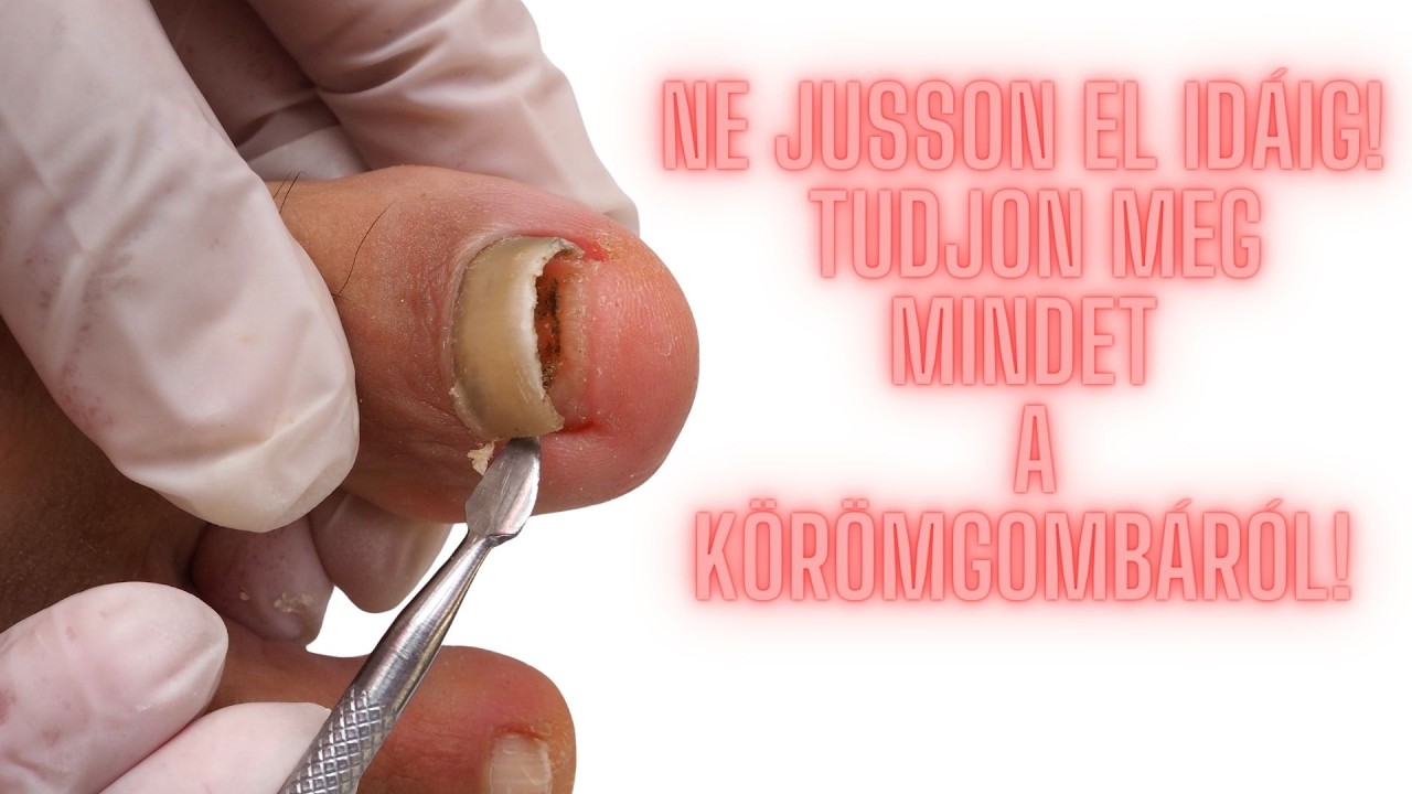 Hogyan szabadulj meg a körömgombától! - A Doktor Válaszol!