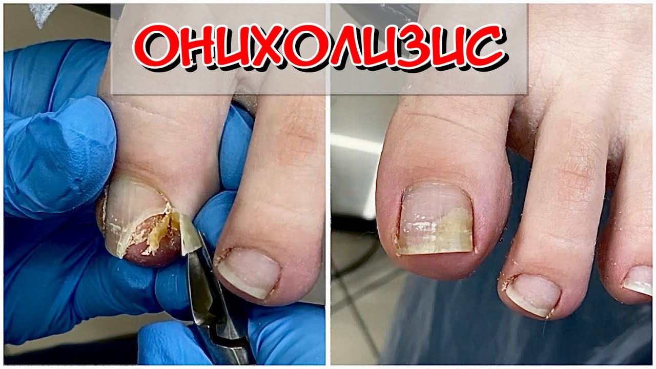 Боковой Онихолизис из-за тесной обуви / Зачем делать зачистку?