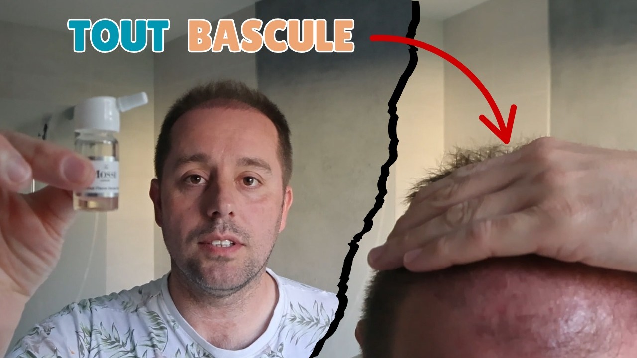 3 mois après ma greffe de cheveux (ce moment où tout bascule)