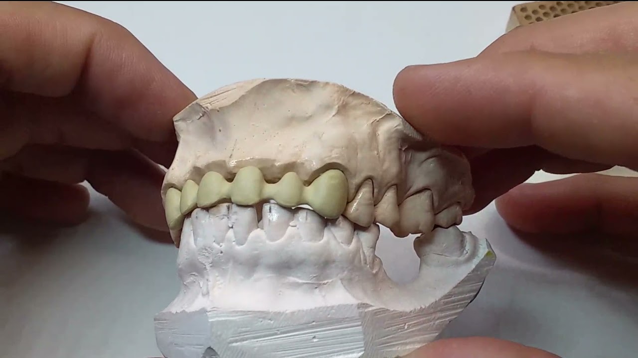 Prótese Fixa 6 elementos - Aplicação metalocerâmica. Noritake Super EX-3