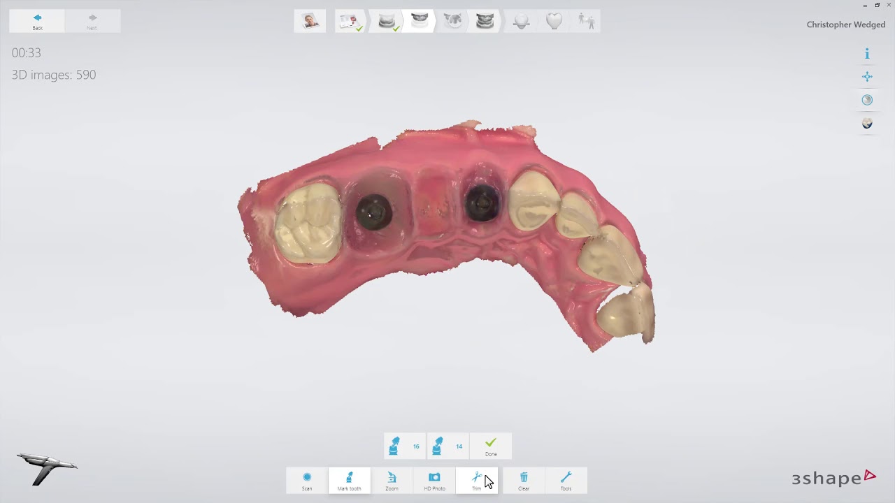 3ShapeTRIOS - Implant Bridge Workflow PL