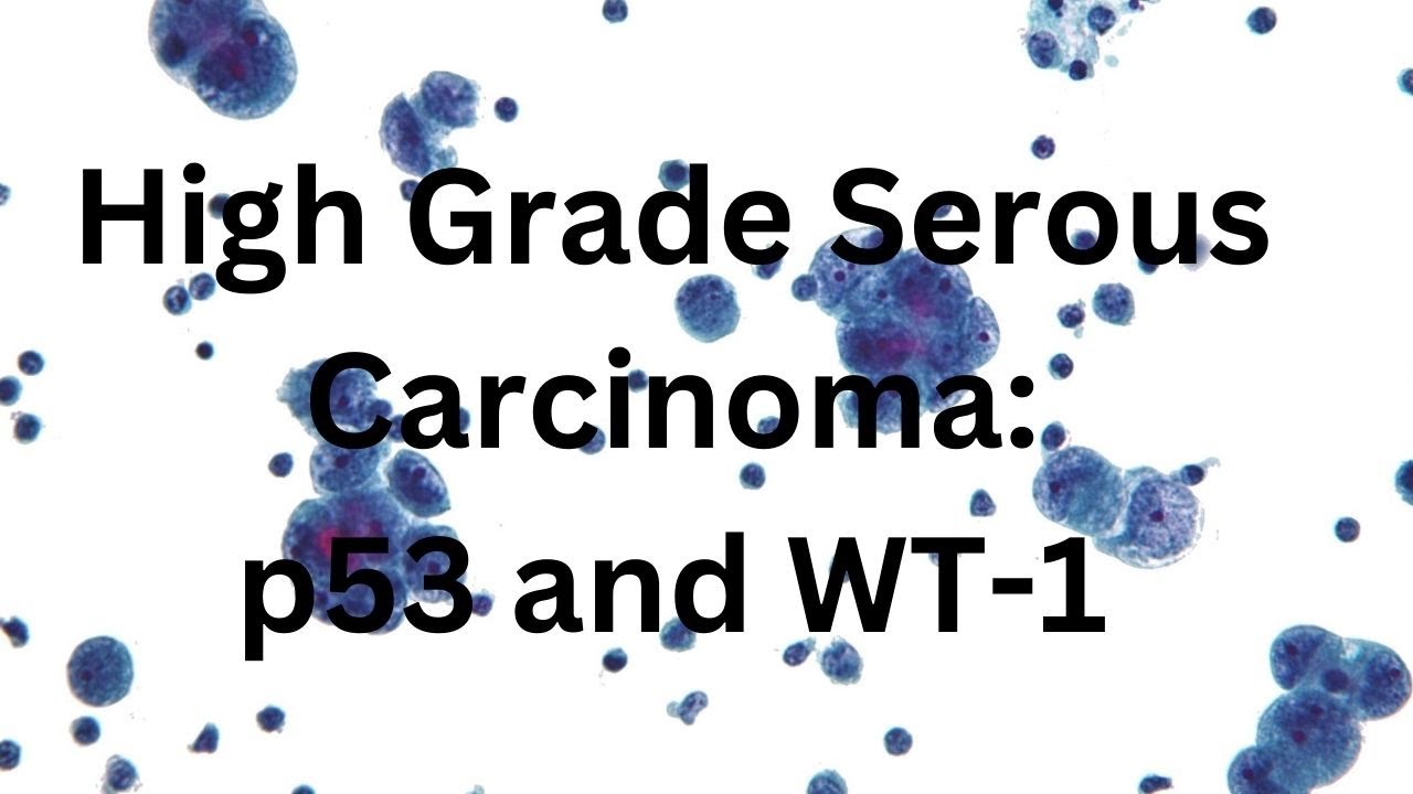 WT-1 and p53: High Grade Ovarian Serous Carcinoma